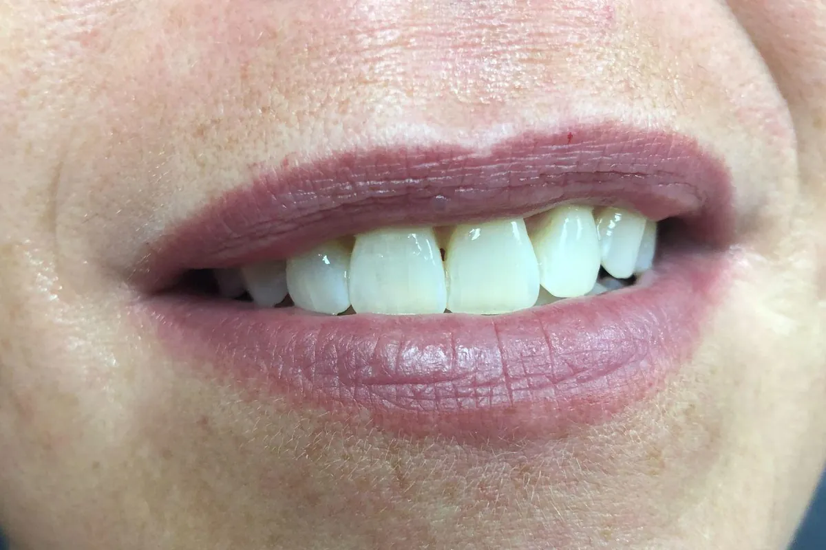 Before: a smiling client's lips in a muted, dusty rose tone